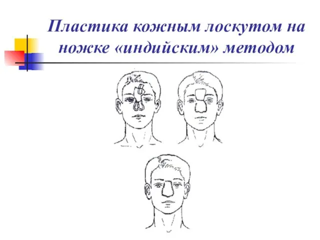 Пластика кожным лоскутом на ножке «индийским» методом