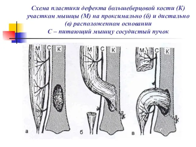 Схема пластики дефекта большеберцовой кости (К) участком мышцы (М) на