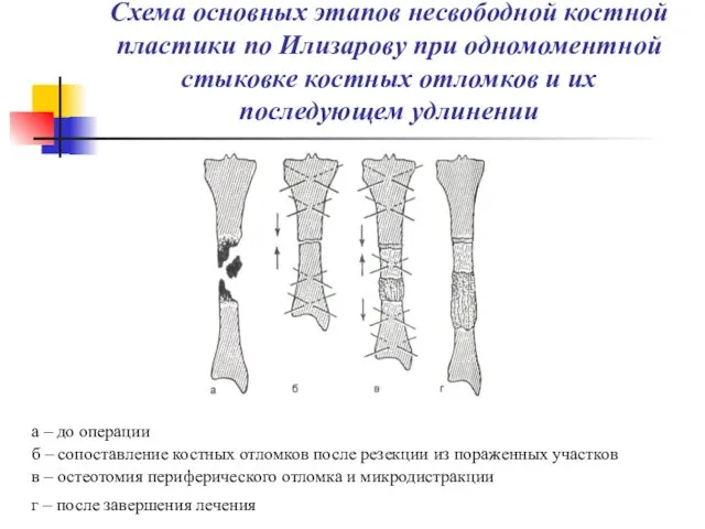 Схема основных этапов несвободной костной пластики по Илизарову при одномоментной