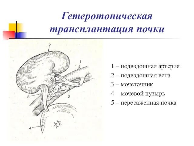 Гетеротопическая трансплантация почки 1 – подвздошная артерия 2 – подвздошная