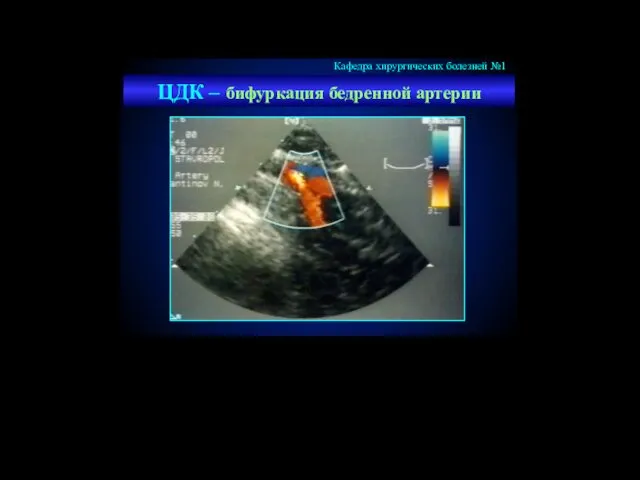 ЦДК – бифуркация бедренной артерии