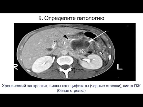 9. Определите патологию Хронический панкреатит, видны кальцификаты (черные стрелки), киста ПЖ (белая стрелка)