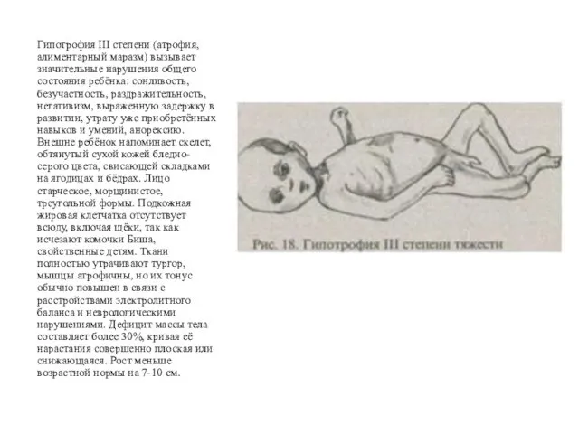 Гипотрофия III степени (атрофия, алиментарный маразм) вызывает значительные нарушения общего