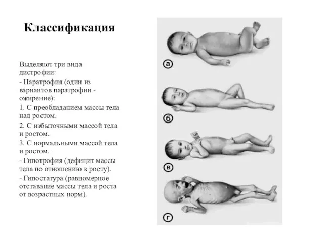 Классификация Выделяют три вида дистрофии: - Паратрофия (один из вариантов