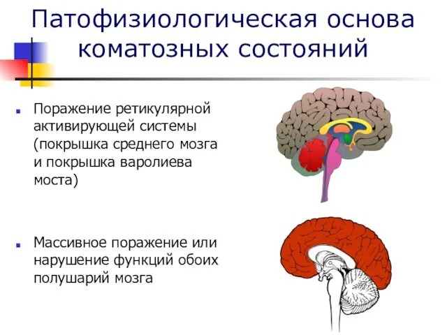 Патофизиологическая основа коматозных состояний Поражение ретикулярной активирующей системы (покрышка среднего