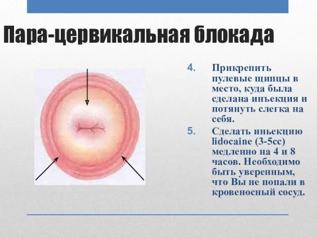 Пара-цервикальная блокада Прикрепить пулевые щипцы в место, куда была сделана