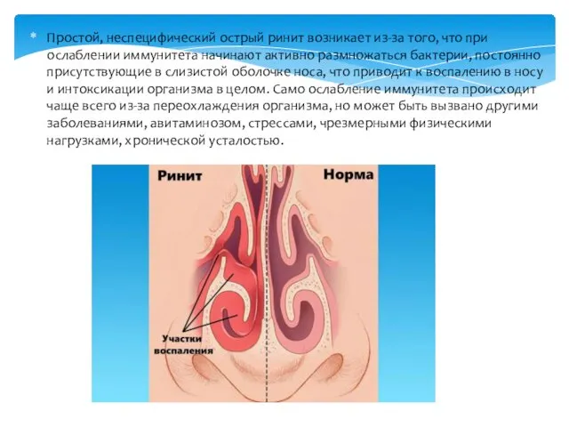 Простой, неспецифический острый ринит возникает из-за того, что при ослаблении