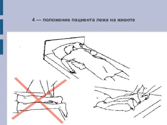 4 — положение пациента лежа на животе