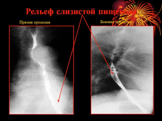 Рельеф слизистой пищевода Прямая проекция Боковая проекция