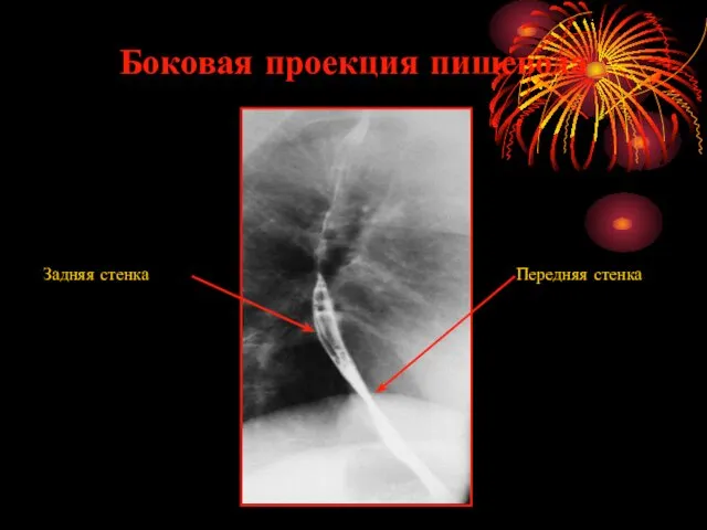 Боковая проекция пищевода Задняя стенка Передняя стенка