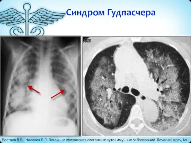 Синдром Гудпасчера Бестаев Д.В., Насонов Е.Л. Легочные проявления системных аутоиммунных заболеваний. Лечащий врач, № 7, 2014.