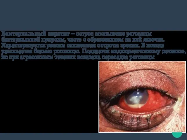 Симптомы бактериального кератита резкая боль в глазу слезотечение, светобоязнь слизисто-гнойное