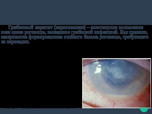 Симптомы грибкового кератита: ощущение инородного тела в глазу корнеальный синдром