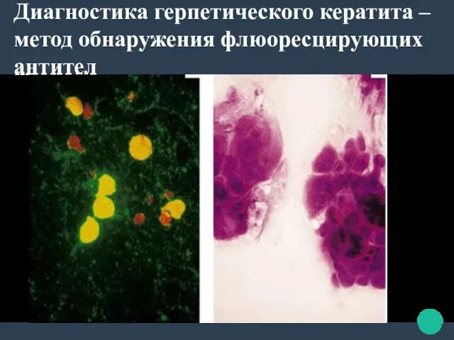 Диагностика герпетического кератита – метод обнаружения флюоресцирующих антител