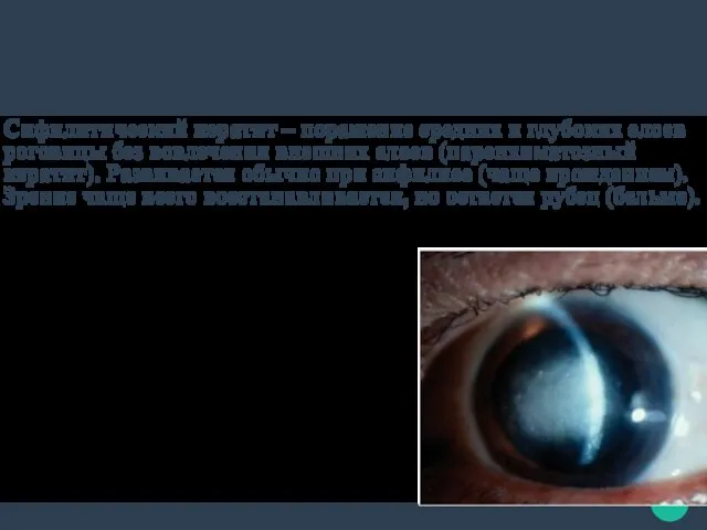 Симптомы сифилитического кератита боль в глазу, светобоязнь, слезотечение, снижение остроты
