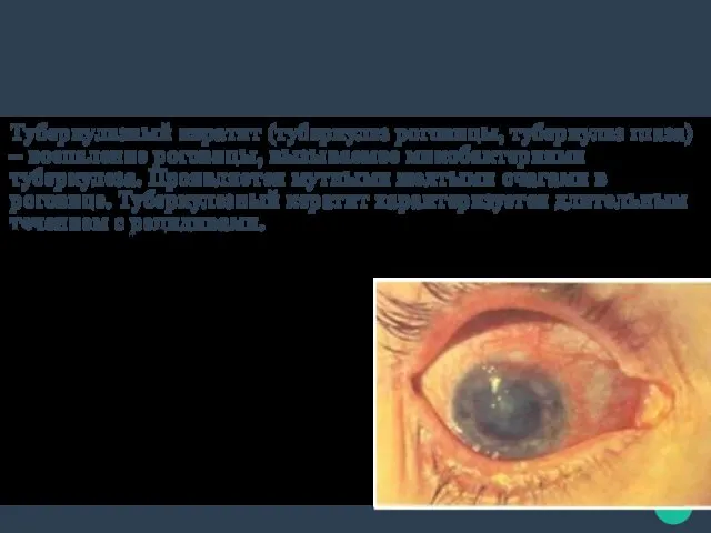 Симптомы туберкулезного кератита ощущение инородного тела,боль в глазу, корнеальный синдром