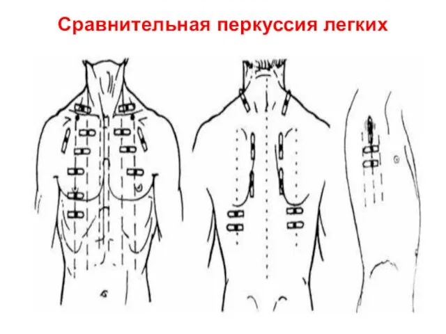 Сравнительная перкуссия легких