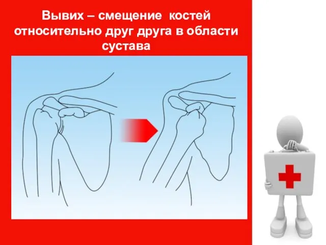 Вывих – смещение костей относительно друг друга в области сустава