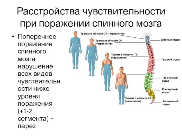 Расстройства чувствительности при поражении спинного мозга Поперечное поражение спинного мозга