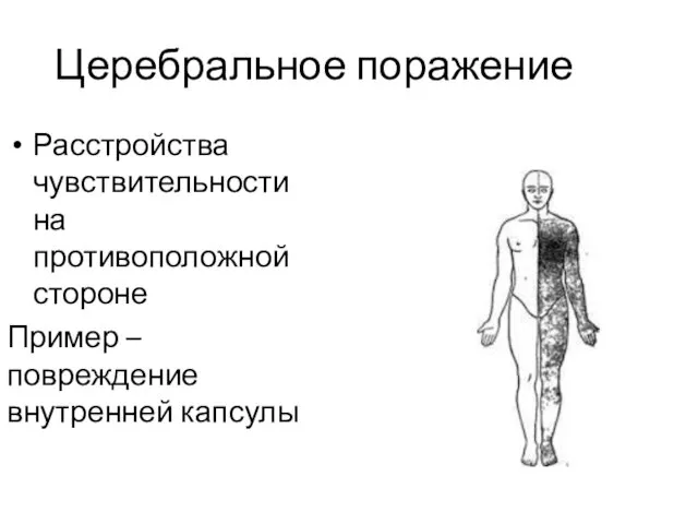 Церебральное поражение Расстройства чувствительности на противоположной стороне Пример – повреждение внутренней капсулы