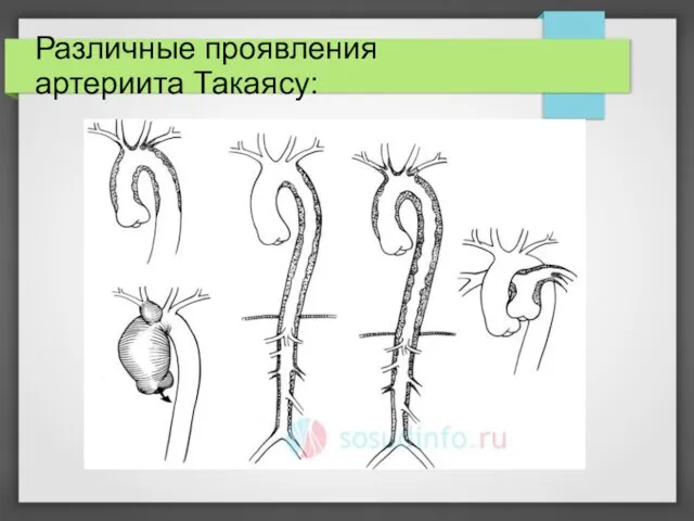 Различные проявления артериита Такаясу: