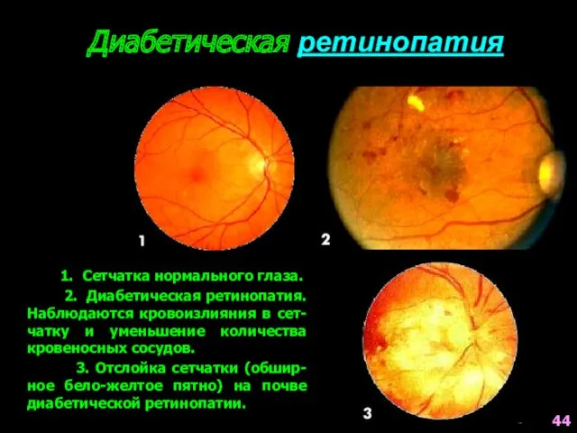 1. Сетчатка нормального глаза. 2. Диабетическая ретинопатия. Наблюдаются кровоизлияния в