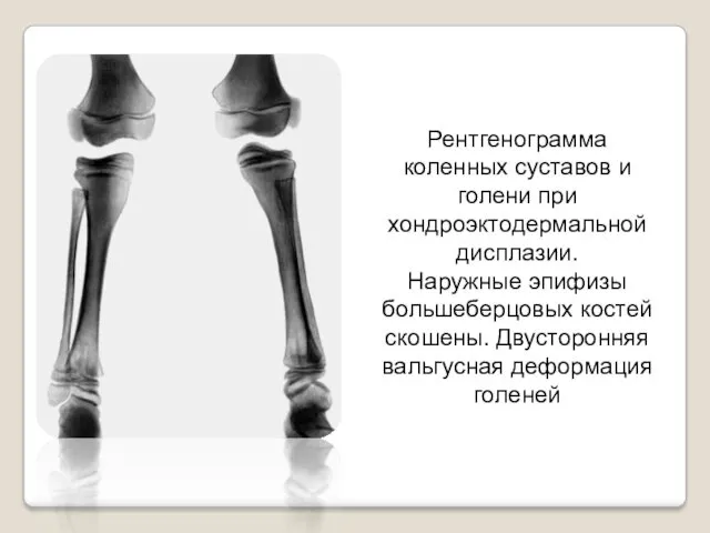 Рентгенограмма коленных суставов и голени при хондроэктодермальной дисплазии. Наружные эпифизы