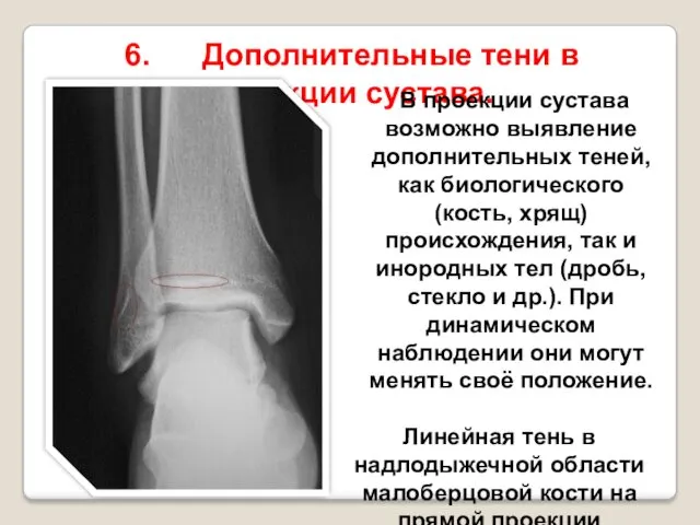 6. Дополнительные тени в проекции сустава. В проекции сустава возможно