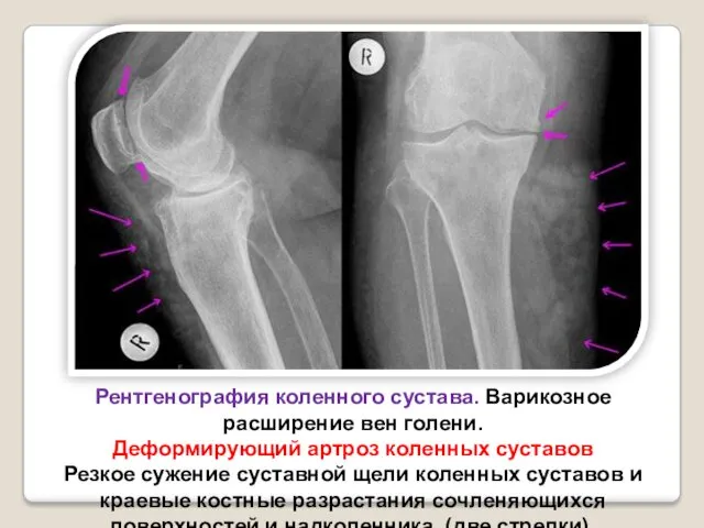 Рентгенография коленного сустава. Варикозное расширение вен голени. Деформирующий артроз коленных