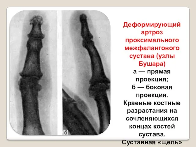 Деформирующий артроз проксимального межфалангового сустава (узлы Бушара) а — прямая