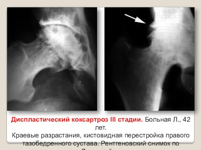 Диспластический коксартроз III стадии. Больная Л., 42 лет. Краевые разрастания,