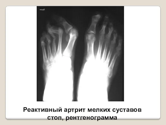 Реактивный артрит мелких суставов стоп, рентгенограмма