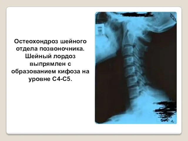 Остеохондроз шейного отдела позвоночника. Шейный лордоз выпрямлен с образованием кифоза на уровне С4-С5.