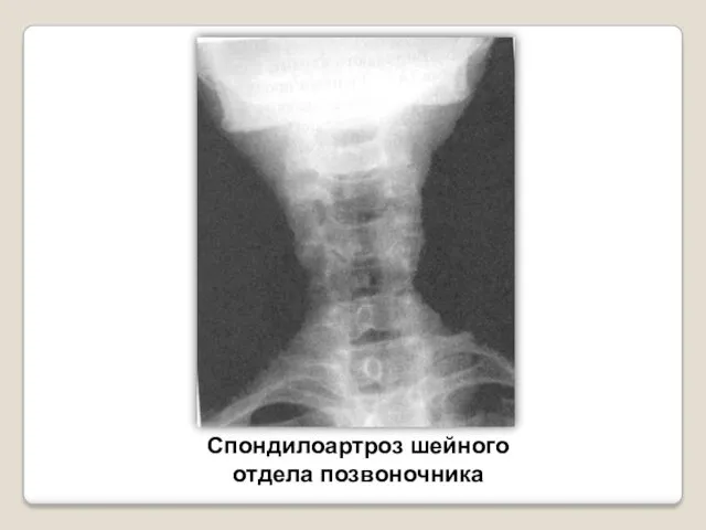 Спондилоартроз шейного отдела позвоночника