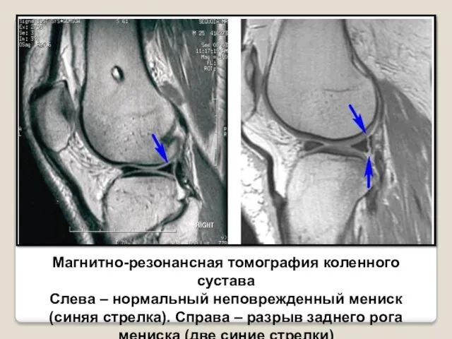 Магнитно-резонансная томография коленного сустава Слева – нормальный неповрежденный мениск (синяя