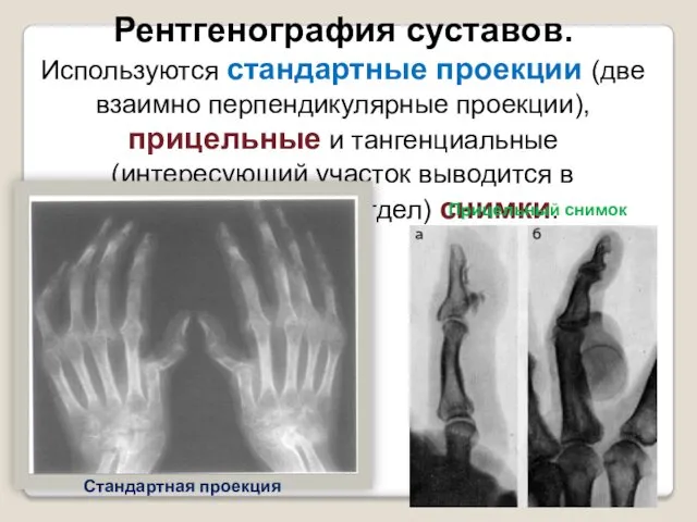 Рентгенография суставов. Используются стандартные проекции (две взаимно перпендикулярные проекции), прицельные