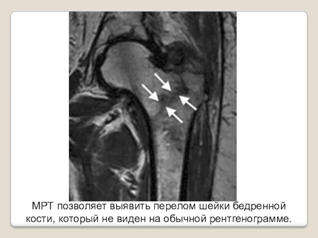МРТ позволяет выявить перелом шейки бедренной кости, который не виден на обычной рентгенограмме.