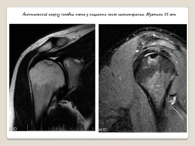 Асептический некроз головки плеча у пациента после химиотерапии. Мужчина 33 лет