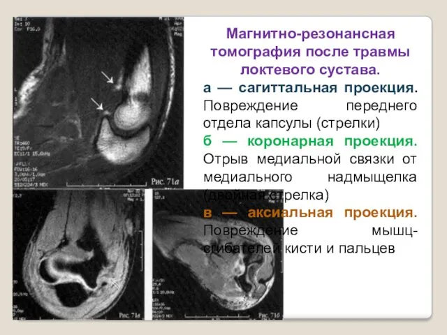 Магнитно-резонансная томография после травмы локтевого сустава. а — сагиттальная проекция.