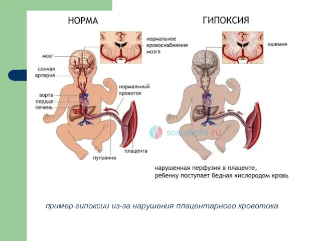 пример гипоксии из-за нарушения плацентарного кровотока