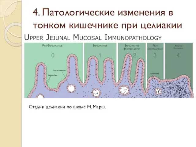 4. Патологические изменения в тонком кишечнике при целиакии Стадии целиакии по шкале М. Марш.
