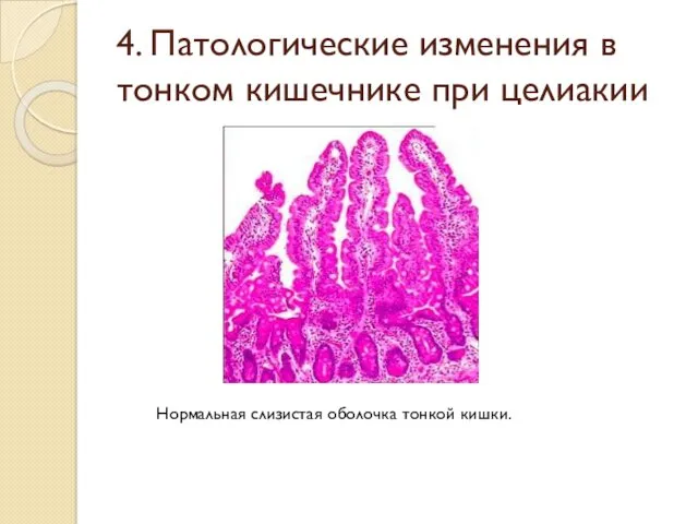 4. Патологические изменения в тонком кишечнике при целиакии Нормальная слизистая оболочка тонкой кишки.