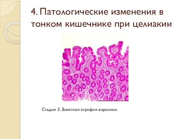 4. Патологические изменения в тонком кишечнике при целиакии Стадия 3. Заметная атрофия ворсинок.
