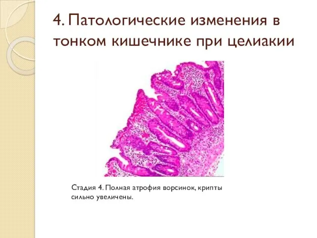 4. Патологические изменения в тонком кишечнике при целиакии Стадия 4. Полная атрофия ворсинок, крипты сильно увеличены.