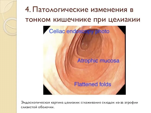 4. Патологические изменения в тонком кишечнике при целиакии Эндоскопическая картина целиакии: сглаживание складок