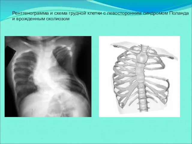 Рентгенограмма и схема грудной клетки с левосторонним синдромом Поланда и врожденным сколиозом