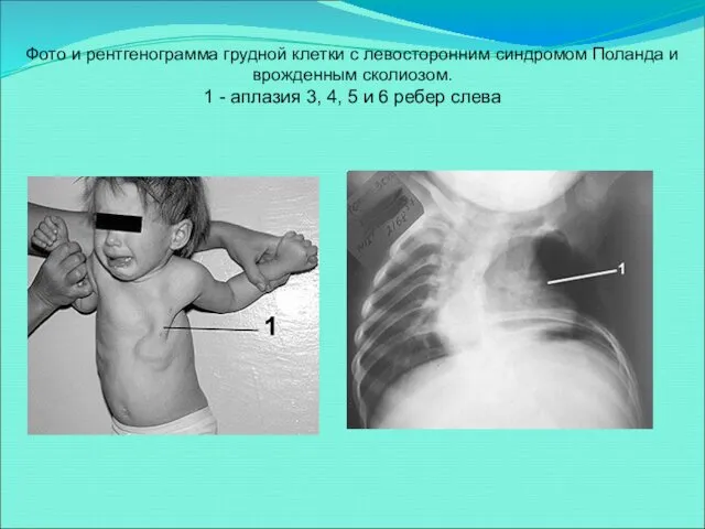 Фото и рентгенограмма грудной клетки с левосторонним синдромом Поланда и