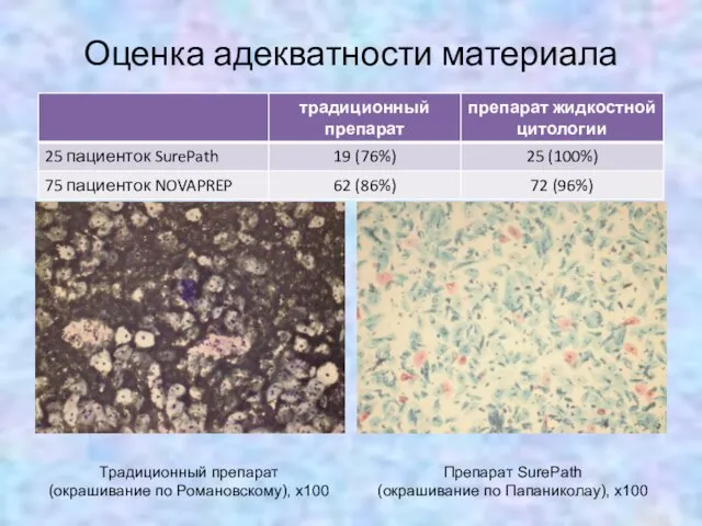 Оценка адекватности материала Традиционный препарат (окрашивание по Романовскому), х100 Препарат SurePath (окрашивание по Папаниколау), х100