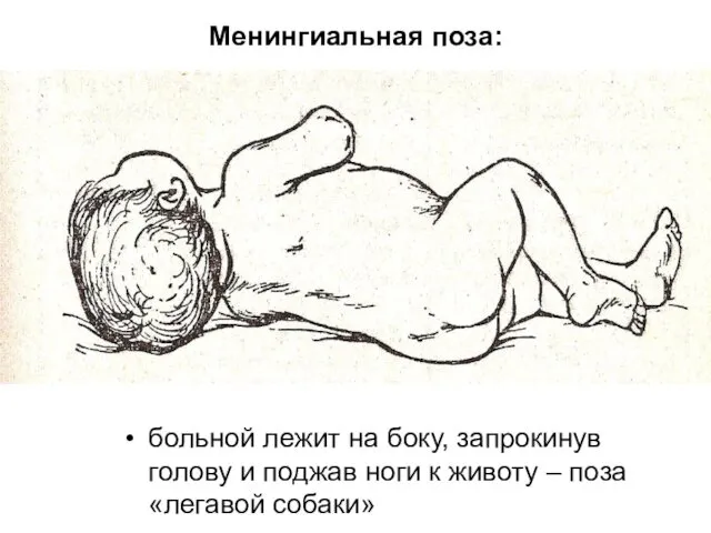 Менингиальная поза: больной лежит на боку, запрокинув голову и поджав ноги к животу