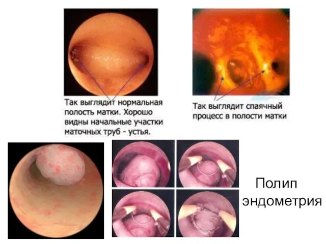 Полип эндометрия